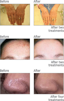 Treatments Side Image